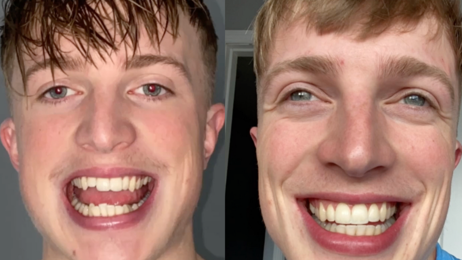 6 month braces testimonial - Sean Fitz